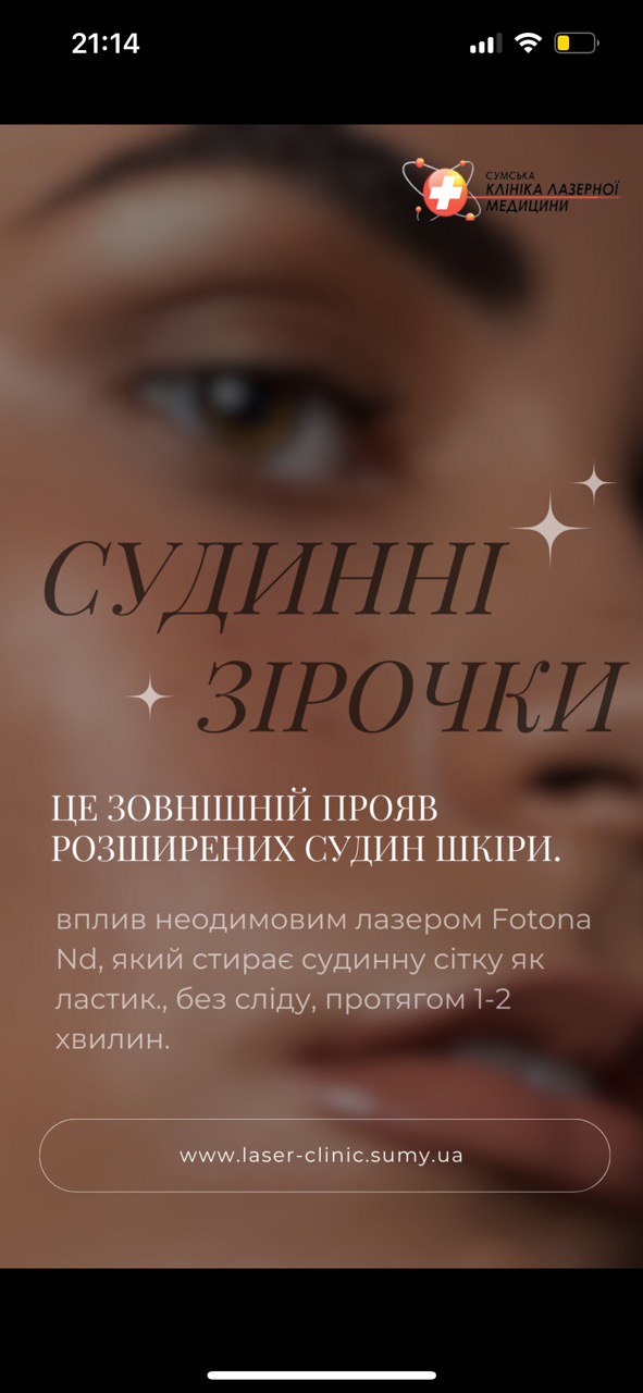 Лікування судинних зірочок